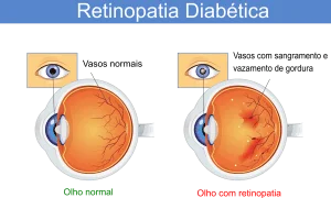 retinopatia-diabetica-300x180-1