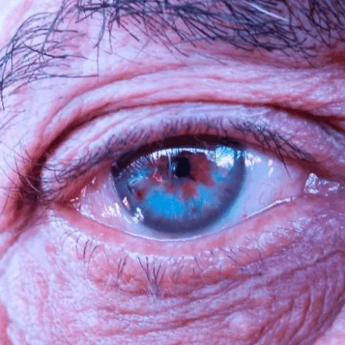 Retinopatia Diabética: o que preciso saber?